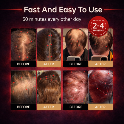 MARTGGOO™ Red Light Therapy Regrowth Cap -LGZ